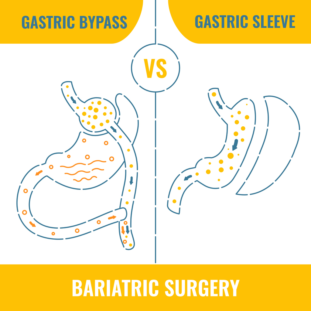 Hoe helpt een gastric sleeve om te vermageren? En wat is het verschil met een gastric bypass?