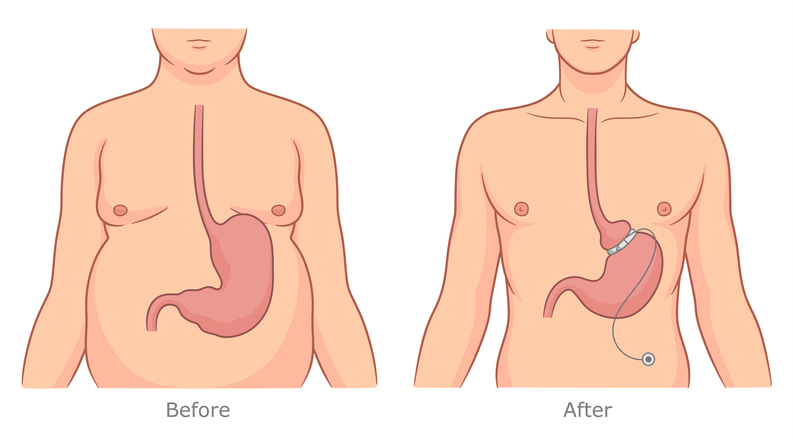 Illustratie: voor en na gastric banding